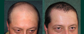 Hairdoctors Calculadora de Implantes Hairdoctors Calculadora de implantes